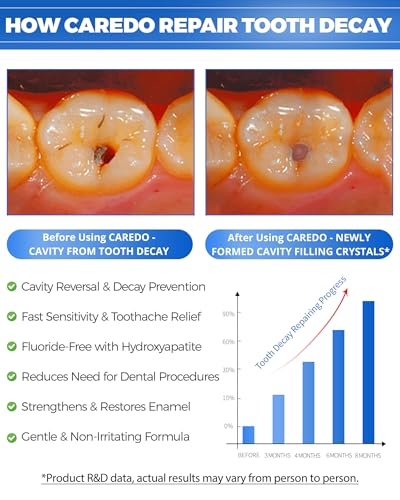 Cavity Reversal Hydroxyapatite Toothpaste for Adults
| Cavity Tooth Filler as Home Cavity Repair
| Fluoride Free Revers
